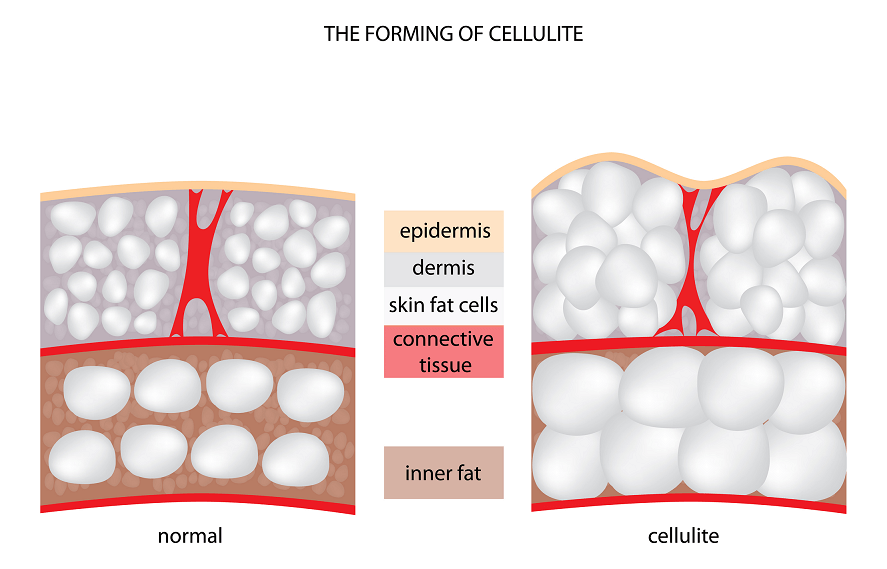 Understanding Cellulite 3 cellulite-1