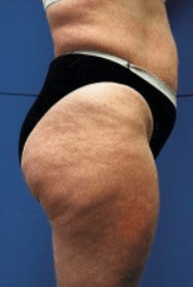 Understanding Cellulite 4 cellulite-111