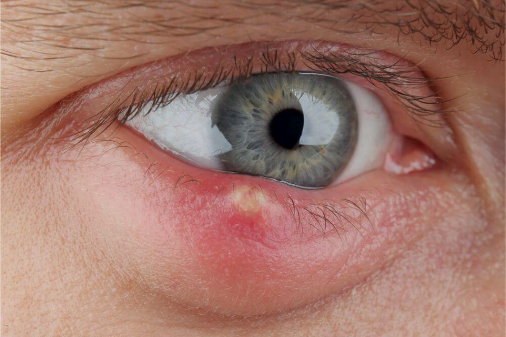How to Get Rid of a Stye