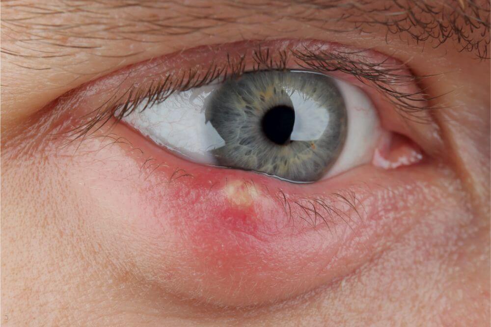 How To Get Rid Of A Stye Health Faire